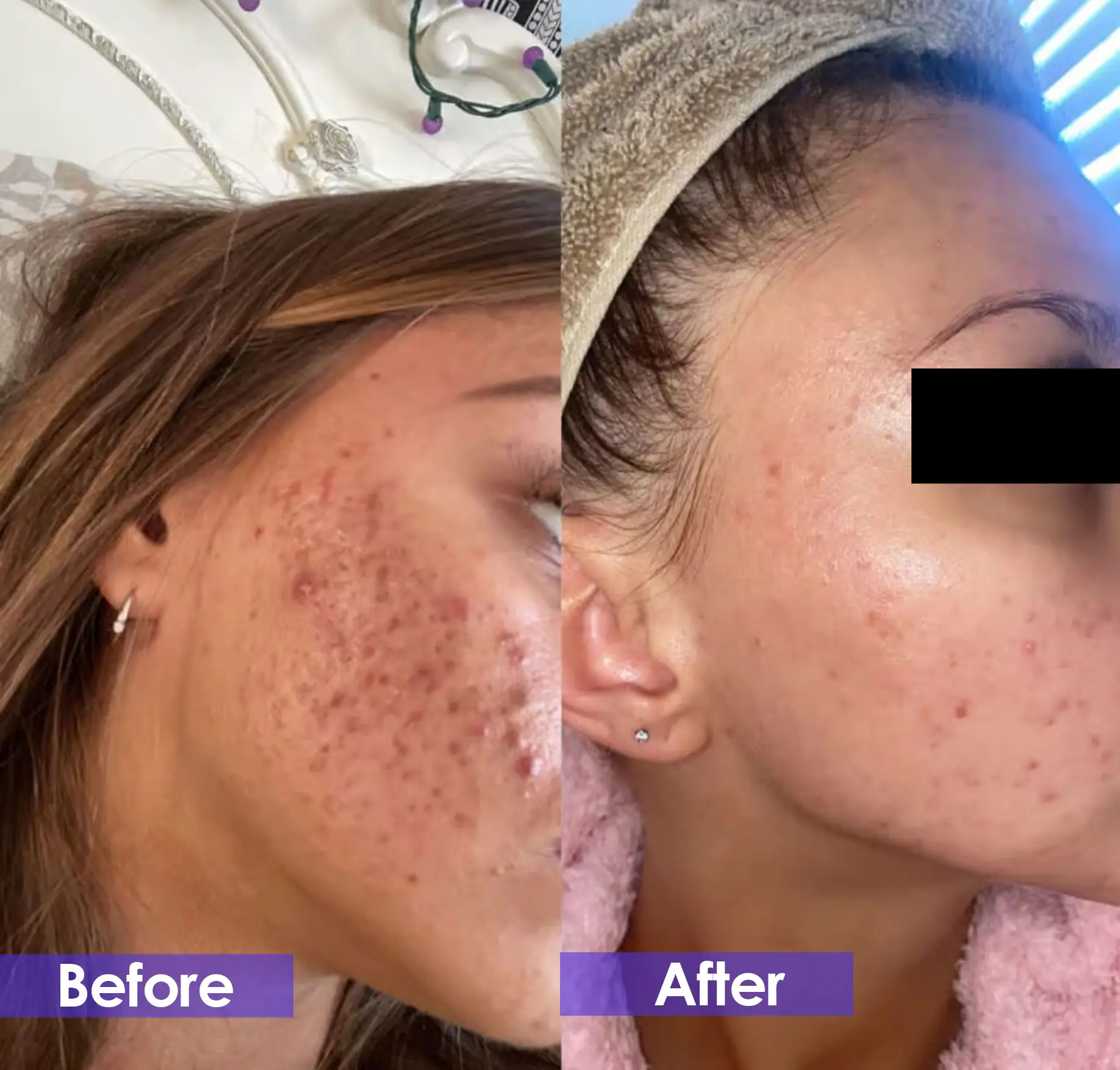 CO2 Laser treatments for skin rejuvenation